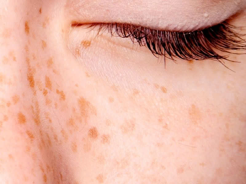 điều trị nám đinh