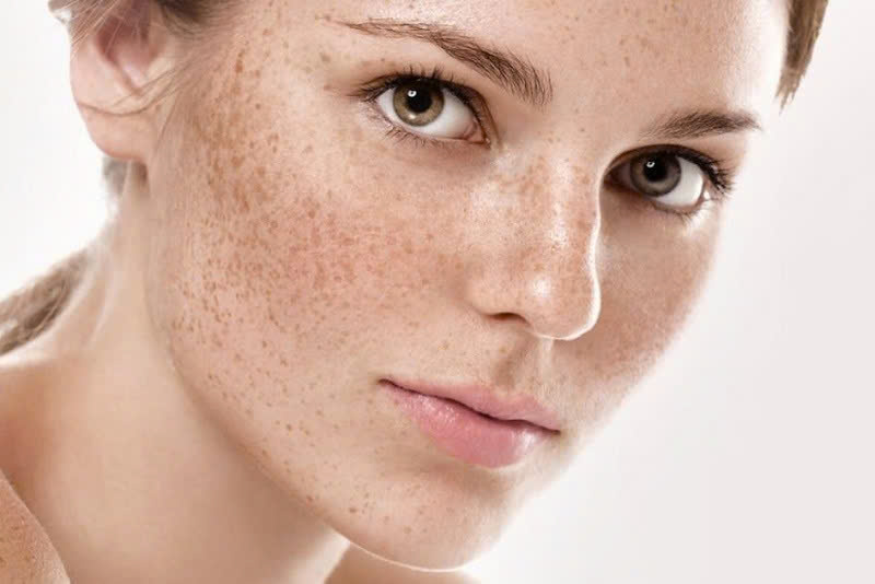 điều trị đồi mồi