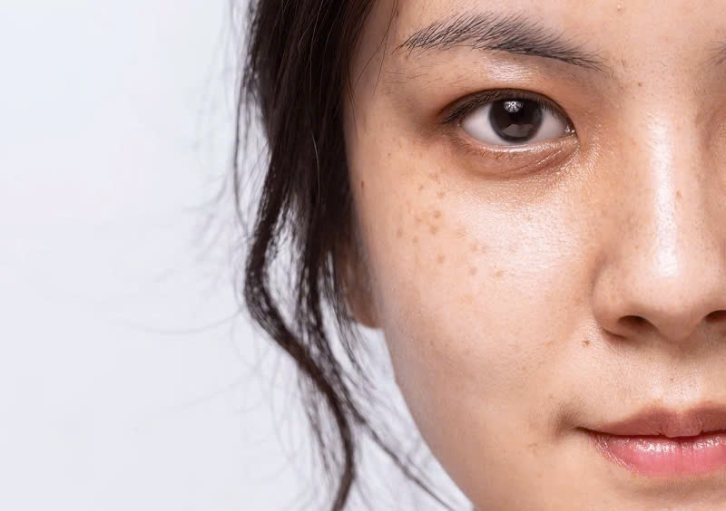 điều trị nám đinh