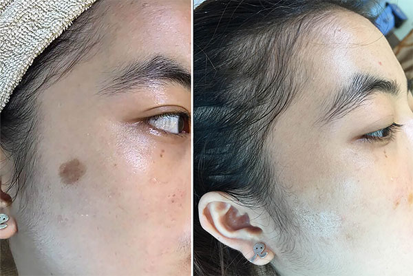 điều trị đồi mồi