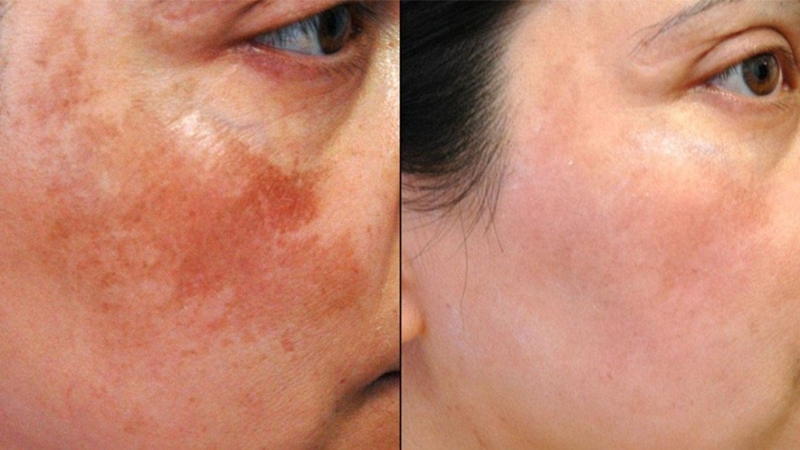 điều trị nám mảng