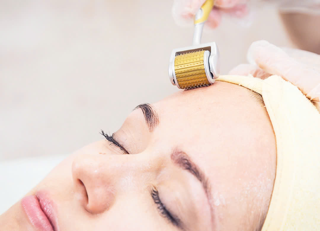 điều trị sẹo rỗ