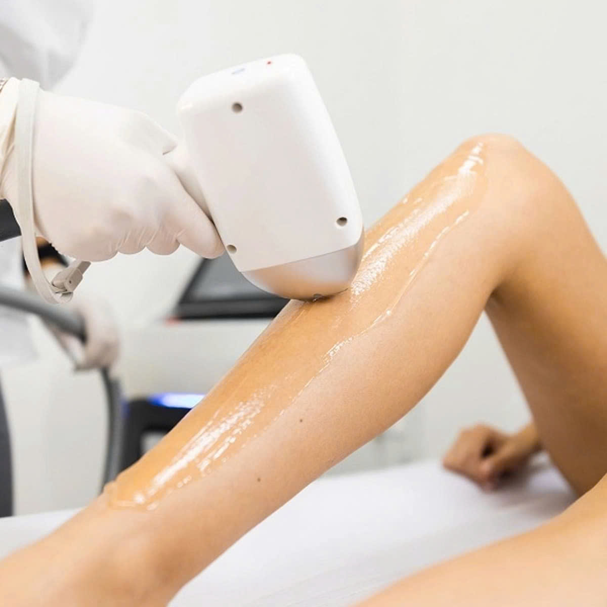 triệt lông 1/2 chân