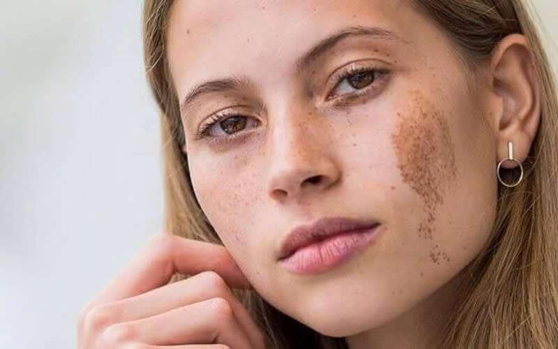 điều trị bớt sắc tố