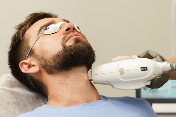 triệt mép cằm nam