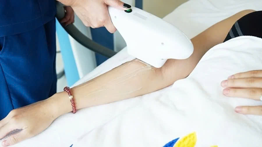 triệt lông 1/2 cánh tay