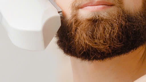 triệt mép cằm nam