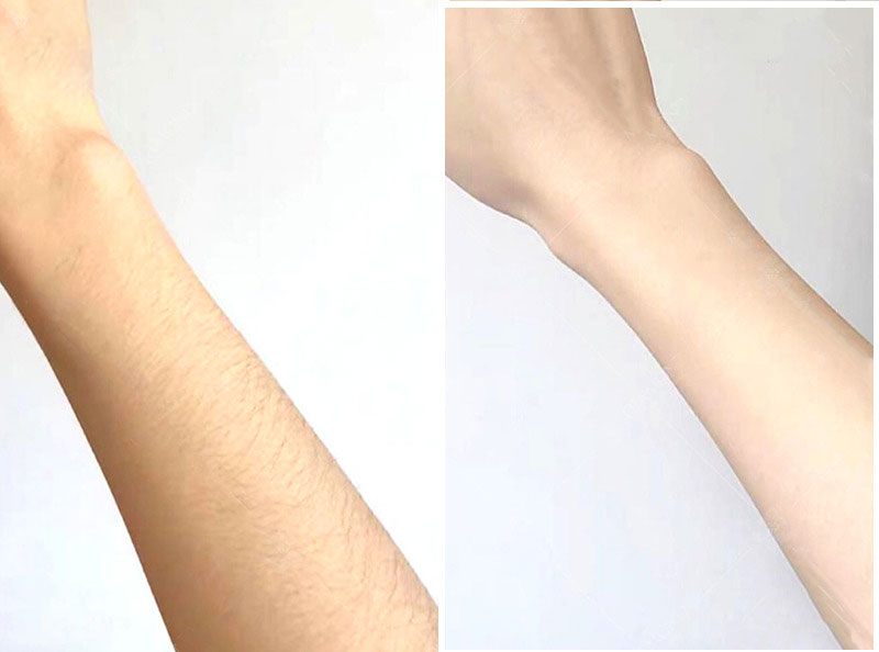 triệt lông 1/2 cánh tay