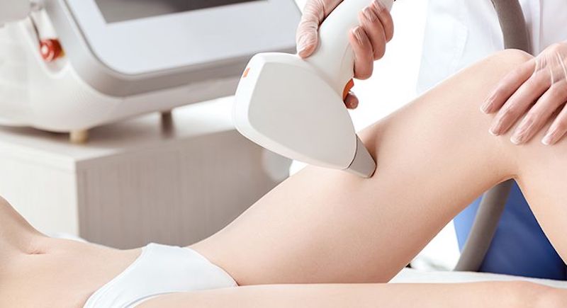 triệt lông bikini