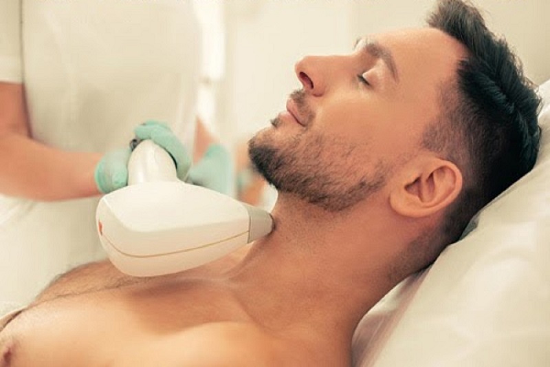 triệt mép cằm nam