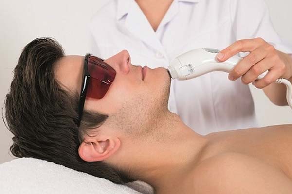 triệt mép cằm nam